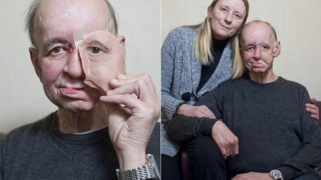 3D Printing Disabilities Facial Prosthetic